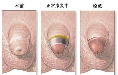呼和浩特哪家医院做包皮手术做的好