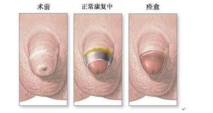 呼和浩特包皮手术哪种方法好？